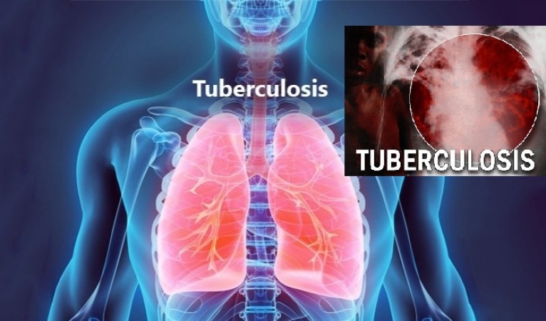 Stakeholders worry over shortage of tuberculosis drugs in Akwa Ibom
