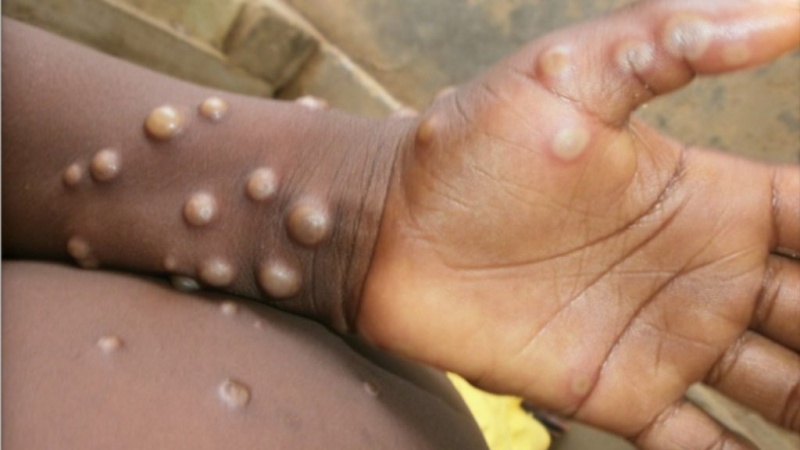 Cross River, Lagos lead as Mpox spreads to 63 LGs