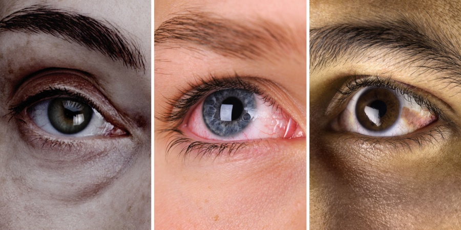 What the colour of your eyes says about your health
