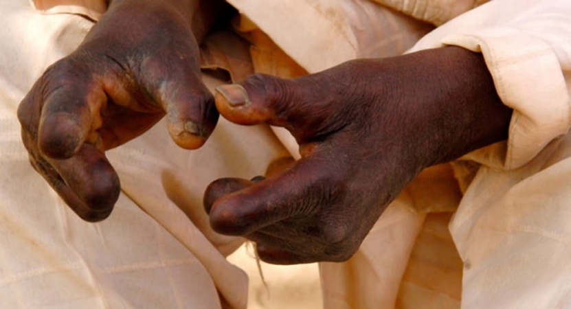 Rights group raises alarm over 3,000 leprosy patients left without access to drugs