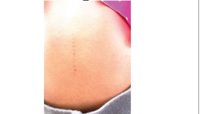 Parents tackle school as children fall sick after bodily incisions