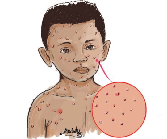 We?ve lost 5 children to measles outbreak, Kaduna village head laments