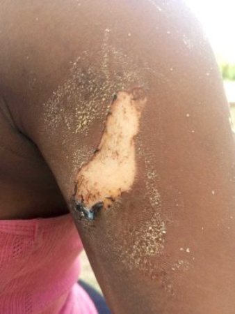 Tailor burns teenage customer with hot iron over clothing dispute
