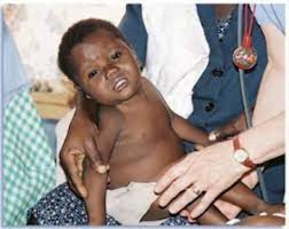 150,000 Nigerian children born with sickle cell gene annually ? FG