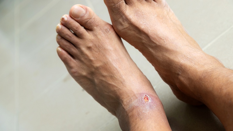 Avoid walking barefoot if you have diabetes ? Expert