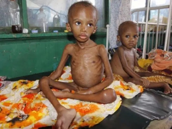 Surge in child malnutrition in Northern Nigerian worrisome ? Nwabueze