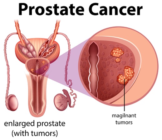 Prostate cancer: 5 early symptoms men shouldn?t ignore