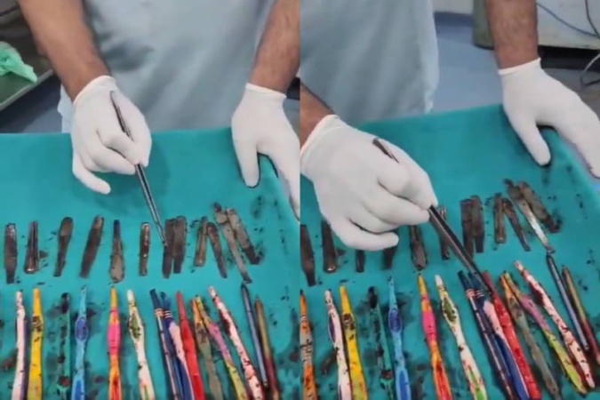 Doctors remove 29 spoons, 19 toothbrushes, and pens from man?s stomach