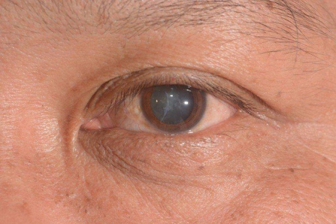 Over 94 million people battle cataract globally, five key facts to know