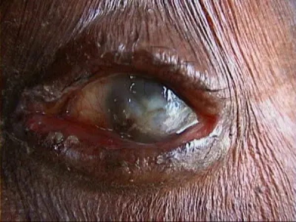 4.24m Nigerians affected by blindness, visual impairment ? Sightsavers