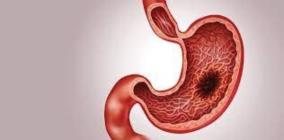 How to manage, prevent stomach cancer ? Medical experts