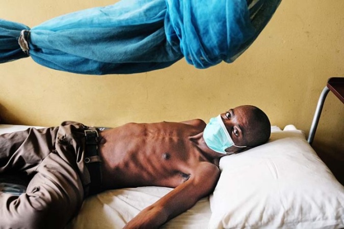 Tuberculosis killed 1.23 million globally in 2024 ? WHO