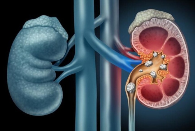 230,000 Nigerians in need of kidney transplant ? Don