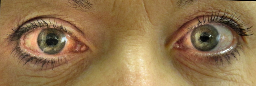 Glaucoma: 12–14m Nigerians at risk of vision loss — FG 