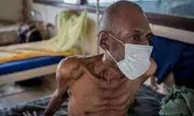 Nigeria ranks first in Africa for tuberculosis prevalence- Experts