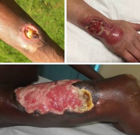 Buruli ulcer kills 7 in Niger community