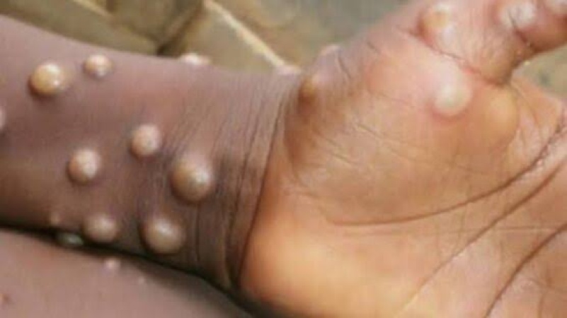Benue investigates suspected Mpox case