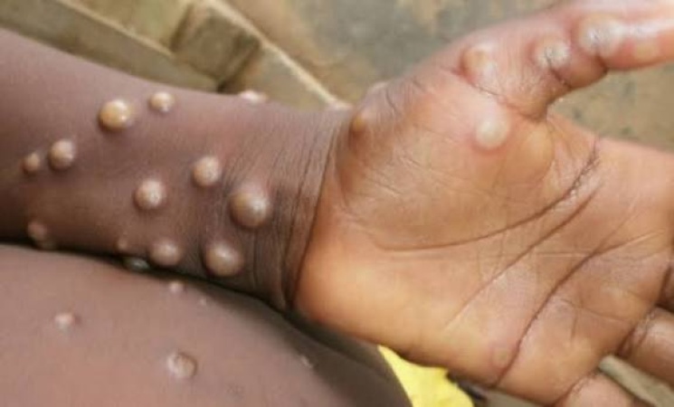 Benue rules out Mpox outbreak, confirms chickenpox cases