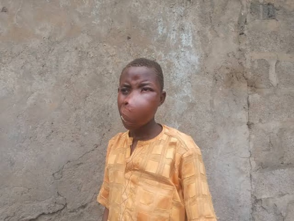 Kano teen battles deadly facial tumour, begs for surgery support