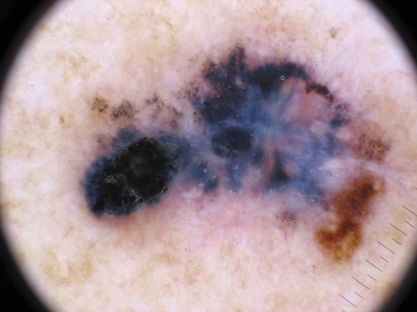 Moderna, Merck breakthrough could usher in wave of cancer vaccines