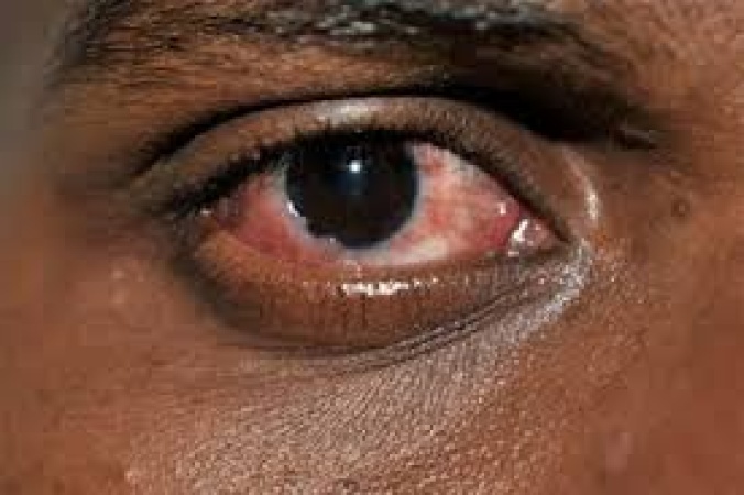 Conjunctivitis reaches epidemic level in Potiskum, Hospital warns