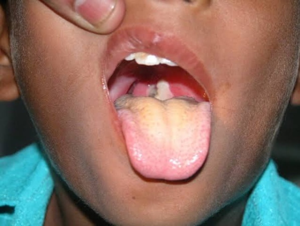 Diphtheria kills 50 children in Kano