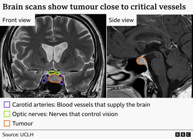 World's first patient to undergo live AI-assisted brain surgery has tumour removed
