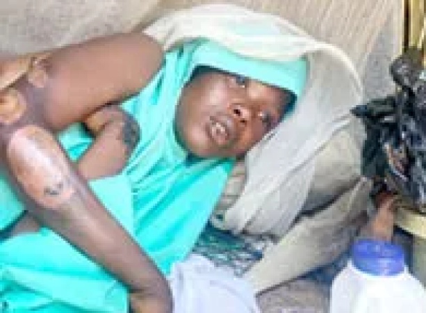 Angry woman burns breastfeeding stepdaughter with hot water following verbal argument
