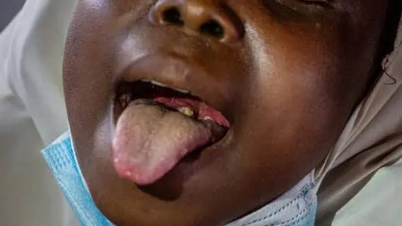 Kano govt sets up committee to contain diphtheria outbreak
