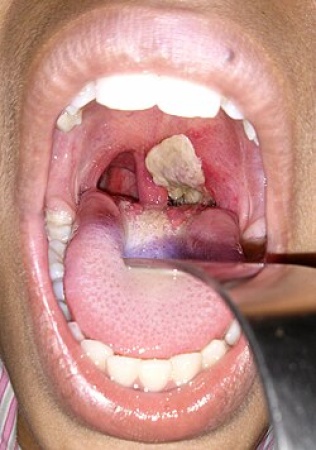 Plateau Resident: I lost 2 grandchildren to diphtheria in one week