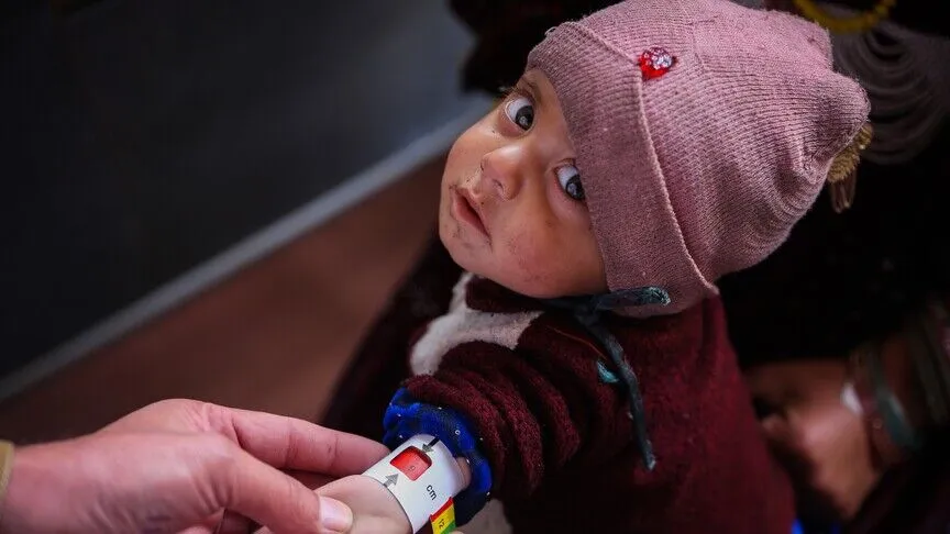3.7M Afghan children suffering from acute malnutrition, UNICEF says Hospitals face growing pressure as severe cases with medical complications rise by one-third Seyma Erkul Dayanc 25 August 2026 • Update: 25 August 2026 Content media ISTANBUL Around 3.7 million children in Afghanistan are suffering from wasting, including about 1 million with life-threatening severe acute malnutrition, UNICEF said Tuesday. UNICEF Representative in Afghanistan Tajudeen Oyewale said nearly 40% of children admitted to hospitals with severe wasting and medical complications are babies under 6 months old. Children under 2 account for 83% of severe acute malnutrition cases, he said. More than half a million children have been admitted since the beginning of the year for high-risk moderate wasting and severe wasting, according to Oyewale. The number of severe acute malnutrition cases admitted with medical complications rose by one-third, from 6,000 in July 2025 to 8,000 by July 2026, he said. “In parts of southern Afghanistan, some hospitals are now seeing three or four severely malnourished children for every available bed,” Oyewale said. UNICEF said half of Afghanistan’s children are living in severe child food poverty, meaning they consume foods from two or fewer food groups a day. Children living in severely food-insecure households can reportedly be up to six times more likely to suffer from wasting during peak malnutrition periods, according to UNICEF. Oyewale said successive years of drought, destructive heavy rainfall and flash floods were compounding the situation, alongside regional instability affecting cross-border trade and livelihoods. Six million people, more than half of them children, have returned to Afghanistan since 2023, placing additional pressure on jobs, household resources and health and nutrition services, he said. More than 100 sites treating children with severe wasting have closed this year compared with 2025 because of resource constraints, UNICEF said. Hundreds of other centers providing nutrition support to children and malnourished pregnant and breastfeeding women have also lost funding, it added. The Nutrition Sector response in Afghanistan faces a 57% funding gap, while UNICEF’s nutrition program, which requires around $180 million this year, is currently 22% funded, according to the agency. “At precisely the moment when the needs are increasing, the services available to children are being reduced due to funding cuts,” Oyewale said.
