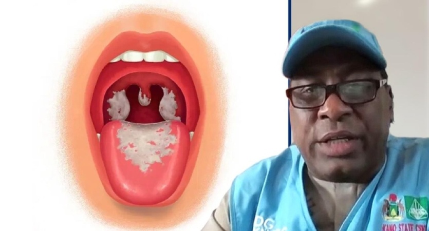 Kano records 32,000 confirmed diphtheria cases, 1,744 deaths — KNCDC