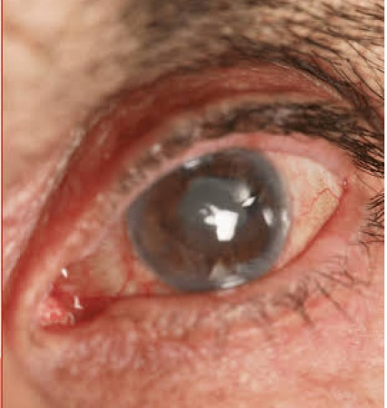 Glaucoma: Experts offer tips on promoting eye health