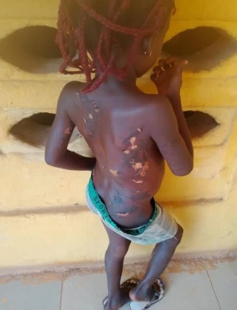 Anambra woman in trouble for burning 7-year-old daughter with hot knife, inflicting injuries