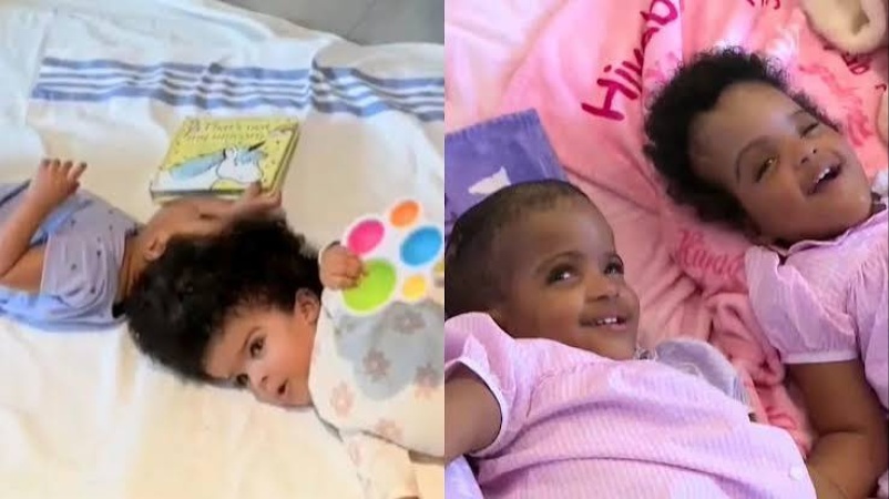 Ethiopia conjoined twins separated after 25-hour surgery in historic medical procedure