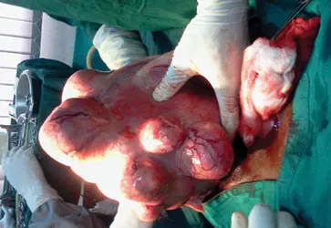 Fibroid without the knife: How sound waves are giving women a new treatment option
