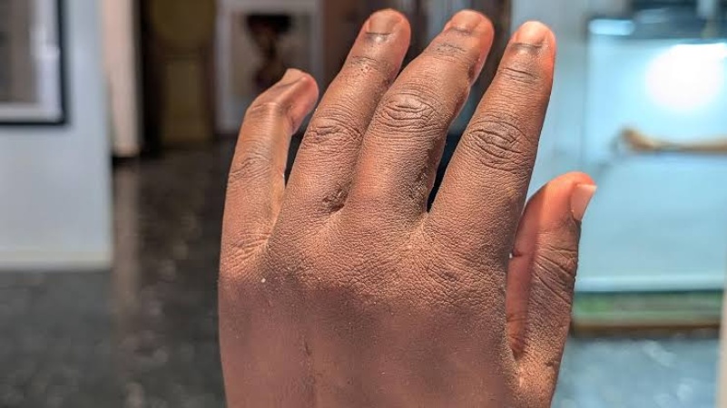 Nigerian-made bionic arm named among TIME’s best inventions of 2026
